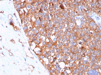 UPK1B Antibody for IHC. Immunohistochemistry analysis of Uroplakin 1B / UPK1B antibody in human urothelial carcinoma tissue using clone UPK1B/3102. FFPE sections show diffuse HRP-DAB brown membranous staining in tumor epithelial cells with a dense, plaque-like surface pattern, consistent with the known localization of UPK1B within urothelial plaque structures. This Urothelial Plaque Structural Protein Antibody highlights the extensive membrane organization and plaque-associated distribution of UPK1B in urothelial tumor cells. HIER: boil tissue sections in pH 9 10mM Tris with 1mM EDTA for 20 minutes followed by cooling prior to staining.