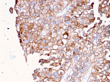 UPK1B Antibody for IHC. Immunohistochemistry analysis of Uroplakin 1B / UPK1B antibody in human urothelial carcinoma tissue using clone UPK1B/3081. FFPE sections demonstrate strong HRP-DAB brown membranous staining in tumor epithelial cells with well-defined cell borders, consistent with localization of this tetraspanin-like membrane protein at the plasma membrane. This Membrane Tetraspanin-like Protein Antibody highlights the characteristic membrane organization and cell surface pattern of UPK1B in urothelial tumor cells. HIER: boil tissue sections in pH 9 10mM Tris with 1mM EDTA for 20 minutes followed by cooling prior to staining.
