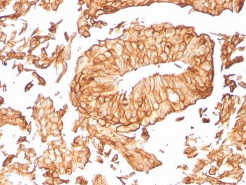 UPK1B Antibody for IHC. Immunohistochemistry analysis of Uroplakin 1B / UPK1B antibody in human urothelial carcinoma tissue using clone UPK1B/3081. FFPE sections show strong HRP-DAB brown membranous staining outlining tumor epithelial cells with a cohesive cell surface pattern, consistent with plasma membrane localization of this tetraspanin-like protein. This Membrane Tetraspanin-like Protein Antibody highlights the organized membrane architecture and surface distribution of UPK1B in urothelial tumor cells. HIER: boil tissue sections in pH 9 10mM Tris with 1mM EDTA for 20 minutes followed by cooling prior to staining.