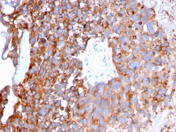 Uroplakin 1B Antibody. Immunohistochemistry analysis of Uroplakin 1B / UPK1B antibody in human urothelial carcinoma tissue using clone UPK1B/3273. FFPE sections demonstrate strong HRP-DAB brown membranous staining in tumor epithelial cells with clear apical surface accentuation, outlining luminal-facing cell borders consistent with polarized urothelial architecture. This Urothelial Apical Surface Protein Antibody highlights the apical membrane localization and surface-oriented distribution of UPK1B in urothelial tumor cells. HIER: boil tissue sections in pH 9 10mM Tris with 1mM EDTA for 20 minutes followed by cooling prior to staining.