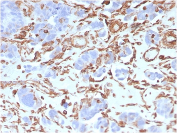 Vimentin Antibody / Mechanotransduction Marker Antibody IHC. Immunohistochemistry analysis of FFPE human colon carcinoma tissue using Vimentin antibody shows strong HRP-DAB brown cytoplasmic staining in stromal and spindle-shaped mesenchymal cells within the tumor microenvironment, with minimal staining in most tumor epithelial cells. The rabbit monoclonal clone VIM/3736 highlights elongated, filamentous cytoplasmic structures aligned along cellular axes, consistent with force-bearing cytoskeletal organization. The distribution and morphology of Vimentin-positive cells support its role in cytoskeletal tension and mechanical signaling within tumor-associated stromal compartments.