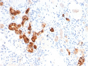 Immunohistochemistry analysis of Calbindin / CALB antibody (clone CALB1/2782) in human kidney tissue. Formalin-fixed, paraffin-embedded human kidney shows cytoplasmic HRP-DAB brown staining in subsets of tubular epithelial cells, while surrounding glomerular and interstitial cells are largely negative. Nuclear counterstain highlights renal architecture. Heat-induced epitope retrieval was performed by boiling tissue sections in pH 9 10 mM Tris with 1 mM EDTA for 20 minutes followed by cooling prior to staining.