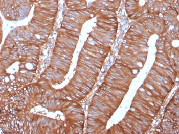 IHC staining of FFPE human colon carcinoma with Calpastatin antibody (clone CAST/1550). HIER: boil tissue sections in pH 9 10mM Tris with 1mM EDTA for 20 min and allow to cool before testing.