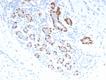 p40 Antibody. Immunohistochemistry analysis of FFPE human breast carcinoma tissue demonstrates focal HRP-DAB brown nuclear staining in tumor cell clusters, while surrounding stromal elements remain largely negative. The nuclear-restricted pattern highlights epithelial cells with basal-like characteristics and supports use of this antibody as an epithelial stratification and differentiation marker, reflecting deltaNp63-associated regulation of epithelial layering and cell state. Staining is heterogeneous across tumor regions, allowing identification of p40-positive subpopulations within the carcinoma. Heat-induced epitope retrieval was performed by boiling tissue sections in pH 9 10mM Tris with 1mM EDTA for 20 minutes followed by cooling prior to antibody incubation.