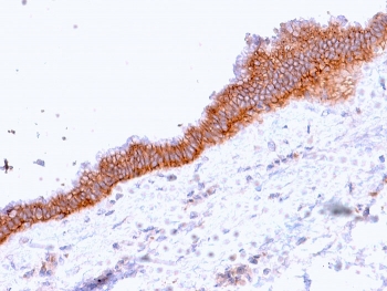 Immunohistochemistry analysis of MRP3 / ABCC3 antibody (clone ABCC3/2971) in human pancreatic carcinoma tissue. Formalin-fixed, paraffin-embedded tumor demonstrates strong membranous HRP-DAB brown staining in epithelial tumor cells, outlining cell borders consistent with plasma membrane localization of Multidrug resistance-associated protein 3. Stromal elements show minimal staining. Hematoxylin counterstain highlights tumor architecture and nuclei. Heat-induced epitope retrieval was performed by boiling tissue sections in pH 9 10 mM Tris with 1 mM EDTA for 20 minutes followed by cooling prior to staining.