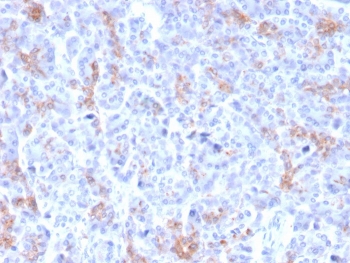 IHC staining of FFPE human pancreatic carcinoma with MRP3 antibody (clone ABCC3/2971). HIER: boil tissue sections in pH 9 10mM Tris with 1mM EDTA for 20 min and allow to cool before testing.