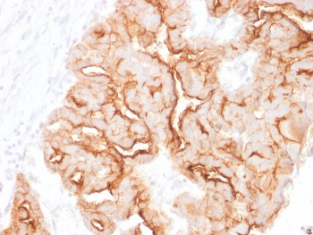 Immunohistochemistry analysis of Mucin 16 Antibody (Clone MUC16/1860) in FFPE human ovarian carcinoma tissue. Strong apical and membranous HRP-DAB brown staining is observed in malignant epithelial cells forming papillary and glandular structures, consistent with MUC16 / CA125 overexpression in ovarian carcinoma, while surrounding stromal elements are largely negative. Heat-induced epitope retrieval was performed in pH 9 Tris-EDTA buffer (10mM Tris, 1mM EDTA) for 20 minutes followed by cooling prior to staining.