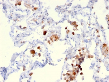 Napsin A Antibody for IHC. Immunohistochemistry analysis of Napsin A (NAPSA) expression in FFPE human lung adenocarcinoma demonstrates distinct granular cytoplasmic HRP-DAB brown staining in tumor epithelial cells, with minimal background in surrounding stromal tissue. Clone NAPSA/3306, a HuProt microarray validated mouse monoclonal antibody, supports highly specific detection of Napsin A consistent with its role as a pulmonary epithelial differentiation marker. HIER was performed by boiling tissue sections in pH 9 10mM Tris with 1mM EDTA for 10-20 minutes followed by cooling at RT for 20 minutes prior to staining.