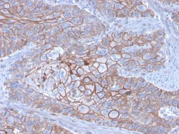 E-Cadherin Antibody Breast Carcinoma IHC. Immunohistochemistry staining of FFPE human breast carcinoma with E-Cadherin antibody (clone CDH1/3256). HIER: boil tissue sections in pH 9 10mM Tris with 1mM EDTA for 20 min and allow to cool before testing.