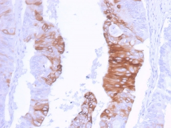 IHC staining of FFPE human colon carcinoma with recombinant CK20 antibody (clone KRT20/3129R). HIER: boil tissue sections in pH 9 10mM Tris with 1mM EDTA for 20 min and allow to cool before testing.