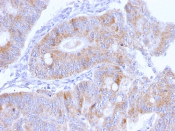 IHC staining of FFPE human colon carcinoma with Thomsen-Friedenreich Antigen antibody (clone A63-C/A9). HIER: boil tissue sections in pH 9 10mM Tris with 1mM EDTA for 20 min and allow to cool before testing.