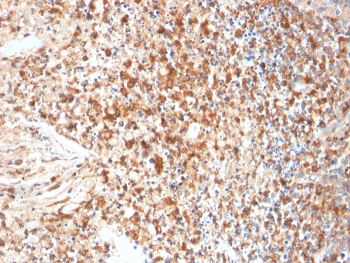 Immunohistochemistry of HSV1 antibody in human cervix tissue. FFPE human cervix sections were subjected to heat-induced epitope retrieval by boiling in pH 9, 10 mM Tris with 1 mM EDTA for 10-20 minutes followed by cooling at room temperature for 20 minutes. The mouse monoclonal HSV1 antibody clone HSVI/2095 was used as the detecting antibody. HRP-DAB brown staining is observed in numerous epithelial and stromal cells, with signal localized predominantly to the nucleus and cytoplasm of positive cells, while adjacent cells show minimal background staining. The staining pattern is consistent with Herpes simplex virus type 1 antigen expression in cervix tissue.