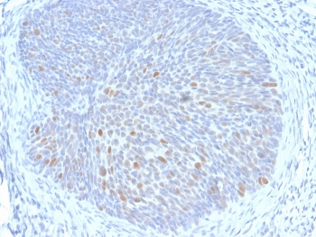 IHC staining of FFPE human cervix with HPV16 E1/E4 antibody. HIER: boil tissue sections in pH 9 10mM Tris with 1mM EDTA for 20 min and allow to cool before testing.