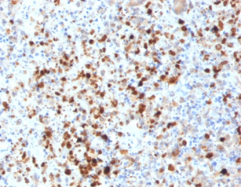 Immunohistochemistry of HSV1 antibody in human cervix tissue. FFPE human cervix sections were subjected to heat-induced epitope retrieval by boiling in pH 9, 10 mM Tris with 1 mM EDTA for 10-20 minutes followed by cooling at room temperature for 20 minutes. The rabbit polyclonal HSV1 antibody was used as the detecting antibody. HRP-DAB brown staining is observed in scattered epithelial and stromal cells, with signal localized predominantly to the nucleus and cytoplasm of positive cells, while surrounding cells show minimal background staining. The staining pattern is consistent with Herpes simplex virus type 1 antigen expression in cervix tissue.