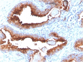 FOLH1 Antibody Prostate Cancer Immunohistochemistry. IHC staining of FFPE human prostate carcinoma with FOLH1 antibody (clone FOLH1/3734). HIER: boil tissue sections in pH 9 10mM Tris with 1mM EDTA for 20 min and allow to cool before testing.