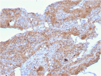 FN1 Antibody Lung Stromal Matrix IHC. Immunohistochemistry analysis of FFPE human lung tissue stained with clone FN1/2948. Diffuse extracellular HRP-DAB brown staining highlights stromal connective tissue and matrix-associated structures consistent with expression of Fibronectin 1 / FN1, a major extracellular matrix glycoprotein involved in tissue remodeling and cellular adhesion pathways. Clone FN1/2948 is supported by HuProt(TM) protein microarray specificity validation demonstrating selective recognition of FN1 in complex extracellular matrix environments. HIER: boil tissue sections in pH 9 10mM Tris with 1mM EDTA for 20 min and allow to cool before testing.