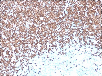 TdT Antibody Thymus IHC. Immunohistochemistry of TdT antibody in human thymus tissue. Formalin-fixed, paraffin-embedded human thymus demonstrates strong nuclear staining in immature cortical thymocytes, consistent with Terminal deoxynucleotidyl transferase expression in developing T lymphoblasts. Heat-induced epitope retrieval was performed by boiling tissue sections in pH 9 10mM Tris with 1mM EDTA for 20 minutes followed by cooling prior to staining. The microarray-validated monoclonal antibody clone TDT/1393 was used as the primary antibody, showing distinct nuclear localization in thymic precursor cells.