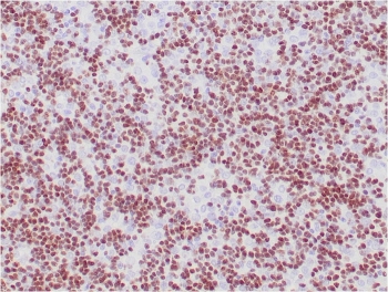 TdT Antibody Thymoma IHC. Immunohistochemistry of TdT antibody in human thymoma tissue. Formalin-fixed, paraffin-embedded human thymoma shows diffuse nuclear staining in neoplastic lymphoid cells, consistent with Terminal deoxynucleotidyl transferase expression in immature T cell populations. Heat-induced epitope retrieval was performed by boiling tissue sections in pH 9 10mM Tris with 1mM EDTA for 20 minutes followed by cooling prior to staining. The microarray-validated monoclonal antibody clone TDT/1393 was used as the primary antibody, demonstrating strong nuclear localization within tumor-associated thymocytes.