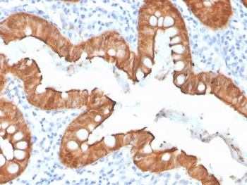 Villin Antibody. Immunohistochemistry analysis of Villin-1 (VIL1) in FFPE human colon using Villin Antibody / Actin-Binding Cytoskeletal Protein Antibody with recombinant rabbit monoclonal clone VIL1/4107R. Strong HRP-DAB brown staining is observed in the apical cytoplasm and membrane of colonic epithelial cells, highlighting regions of active actin filament organization along the luminal surface. The staining pattern is consistent with Villin localization to actin-rich structures and supports its role as an actin-binding cytoskeletal protein involved in filament remodeling within epithelial cells.