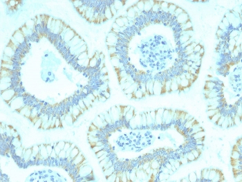 IHC staining of FFPE human colon carcinoma with SMAD4 antibody (clone SMAD4/2440). HIER: boil tissue sections in pH 9 10mM Tris with 1mM EDTA for 20 min and allow to cool before testing.