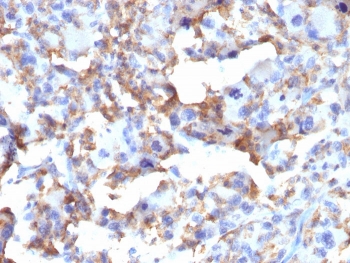 IHC staining of FFPE human histiocytoma with CD163 antibody (clone M130/2163). HIER: boil tissue sections in pH 9 10mM Tris with 1mM EDTA for 20 min and allow to cool before testing.