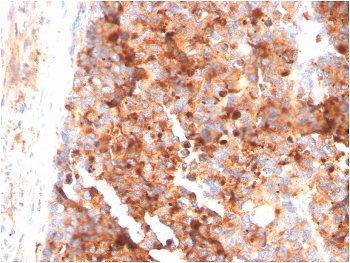 IHC staining of FFPE human melanoma with CD63 antibody (clone LAMP3/3315). HIER: boil tissue sections in pH 9 10mM Tris with 1mM EDTA for 20 min and allow to cool before testing.