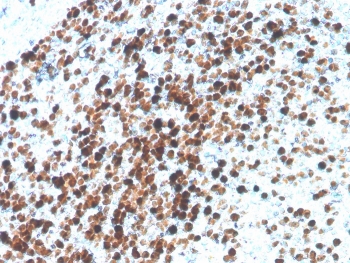 TOP2A Antibody / Topoisomerase II Alpha Antibody (clone TOP2A/4397R). Immunohistochemistry analysis of FFPE human tonsil tissue demonstrates strong nuclear staining consistent with expression of the Topoisomerase II alpha protein in proliferating lymphoid cells. Staining is predominantly localized to nuclei within germinal center lymphocytes, reflecting the role of Topoisomerase II alpha as a DNA replication enzyme highly expressed in actively dividing cells. The Topoisomerase II Alpha Antibody highlights proliferative lymphoid populations within tonsillar tissue, producing a distinct nuclear immunoreactivity pattern typical of cell cycle associated proteins. Antigen retrieval was performed by boiling tissue sections in pH 9 Tris-EDTA buffer prior to immunohistochemistry staining.