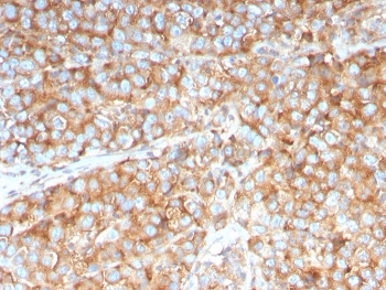 PAI-RBP1 Antibody Urothelial Cancer IHC. Immunohistochemistry analysis of FFPE human urothelial carcinoma tissue stained with PAI-RBP1 Antibody demonstrates widespread cytoplasmic HRP-DAB brown staining across neoplastic epithelial cell populations, consistent with PAI-RBP1 / SERBP1-associated RNA regulatory and translational control pathway expression. This SERPINE1 RNA binding protein antibody highlights post-transcriptional signaling networks and cellular adaptation-associated regulatory biology in urothelial tumor tissue. HIER: boil tissue sections in pH 9 10mM Tris with 1mM EDTA for 20 min and allow to cool before testing.