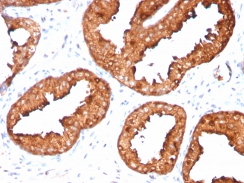 PSA Antibody Recombinant Rabbit MAb KLK3/4551R IHC staining of human prostate carcinoma. Immunohistochemistry analysis of FFPE human prostate carcinoma tissue using PSA Antibody Recombinant Rabbit MAb KLK3/4551R shows strong HRP-DAB brown cytoplasmic staining in malignant prostate epithelial cells forming glandular tumor structures, consistent with Prostate specific antigen (KLK3) expression in prostate-derived carcinoma cells. Surrounding stromal cells remain largely negative. HIER: tissue sections were boiled in pH 9 10mM Tris with 1mM EDTA for 20 minutes and allowed to cool before testing.