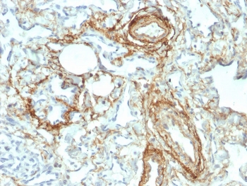 Elastin Antibody IHC Angiosarcoma. Immunohistochemistry analysis of Elastin in human angiosarcoma tissue. Formalin-fixed, paraffin-embedded human angiosarcoma tissue was stained using Elastin antibody (clone ELN/2069), showing prominent extracellular matrix and vessel-associated staining consistent with elastic fiber deposition in tumor-associated vascular structures. Heat-induced epitope retrieval was performed by boiling tissue sections in 10 mM Tris with 1 mM EDTA, pH 9.0, for 20 minutes, followed by cooling prior to immunostaining.