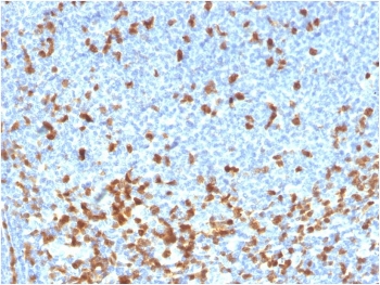 ZAP70 Antibody / T-cell Receptor Signaling Antibody. Immunohistochemistry analysis of formalin-fixed, paraffin-embedded human lymphoma tissue using ZAP70 Antibody / T-cell Receptor Signaling Antibody. Antigen retrieval was performed by boiling sections in pH 9 Tris-EDTA buffer for 20 minutes followed by cooling. Cytoplasmic HRP-DAB brown staining is observed in malignant lymphoid cells and surrounding lymphocyte populations, consistent with Zeta-chain-associated protein kinase 70 (ZAP70) expression in lymphoid-derived cells and its role in T-cell receptor signaling. The staining pattern highlights tumor-associated lymphoid cells and supports the use of ZAP70 for evaluating receptor-mediated signaling within lymphoma tissue architecture.