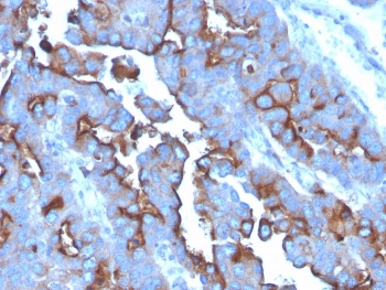 IHC staining of FFPE human tonsil with CD71 antibody (clone TFRC/3630). HIER: boil tissue sections in pH 9 10mM Tris with 1mM EDTA for 20 min and allow to cool before testing.