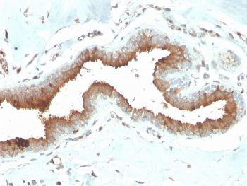 Mammaglobin Antibody Mouse Monoclonal MGB/2704 immunohistochemistry of human breast carcinoma. FFPE human breast carcinoma tissue was stained with Mammaglobin Antibody Mouse Monoclonal (clone MGB/2704). HRP-DAB brown chromogenic signal highlights cytoplasmic staining in tumor epithelial cells lining glandular structures, consistent with Mammaglobin A / SCGB2A2 expression in breast carcinoma cells, while surrounding stromal cells and connective tissue show minimal staining. Heat-induced epitope retrieval was performed by boiling tissue sections in pH 9 10mM Tris with 1mM EDTA for 20 minutes followed by cooling prior to staining.
