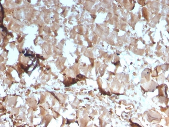 Creatine Kinase M Antibody Skeletal Muscle IHC. Immunohistochemistry analysis of FFPE human skeletal muscle tissue using Creatine Kinase M antibody. The mouse monoclonal antibody clone CKMM/3341 shows strong, diffuse cytoplasmic staining in skeletal myocytes, consistent with Creatine kinase M / CKM expression as a muscle energy metabolism marker. Myofiber cytoplasm displays robust signal reflecting high ATP demand associated with contractile activity, while non-muscle elements show minimal staining. HIER: boil tissue sections in 10 mM Tris with 1 mM EDTA, pH 9, for 20 min followed by cooling prior to staining.