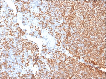 IHC staining of FFPE human thymus with TdT antibody mouse monoclonal. HIER: boil tissue sections in pH 9 10mM Tris with 1mM EDTA for 20 min and allow to cool before testing.