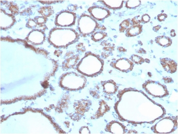 DBC2 Antibody Thyroid IHC. Immunohistochemistry analysis of DBC2 / RHOBTB2 in human thyroid tissue. Formalin-fixed, paraffin-embedded human thyroid tissue was stained with DBC2 antibody. Brown chromogenic signal indicates DBC2-positive epithelial cells within thyroid follicles. Heat-induced epitope retrieval was performed by boiling tissue sections in 10mM Tris with 1mM EDTA, pH 9.0, for 20 minutes followed by cooling prior to antibody incubation.