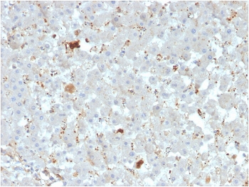 IHC staining of FFPE human liver carcinoma with APOAIV antibody. HIER: boil tissue sections in pH 9 10mM Tris with 1mM EDTA for 20 min and allow to cool before testing.