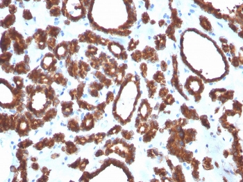 IHC staining of FFPE human thyroid carcinoma with TPO antibody. HIER: boil tissue sections in pH 9 10mM Tris with 1mM EDTA for 20 min and allow to cool before testing.