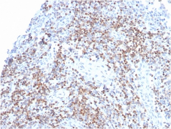 ZAP70 Antibody / Immune Signal Transduction Antibody. Immunohistochemistry analysis of formalin-fixed, paraffin-embedded human tonsil tissue using ZAP70 Antibody / Immune Signal Transduction Antibody. Antigen retrieval was performed by boiling sections in pH 9 Tris-EDTA buffer for 20 minutes followed by cooling. Cytoplasmic HRP-DAB brown staining is observed in lymphoid cell populations within tonsillar follicles and interfollicular regions, consistent with Zeta-chain-associated protein kinase 70 (ZAP70) expression as a central mediator of immune signal transduction. The staining highlights active signaling networks within lymphocyte-rich regions and supports the use of ZAP70 for studying intracellular signal propagation in immune tissue architecture.