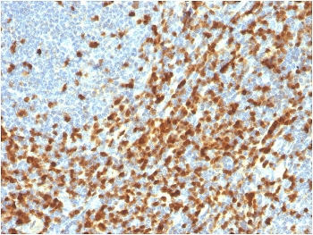 ZAP70 Antibody / Immune Signal Transduction Antibody. Immunohistochemistry analysis of formalin-fixed, paraffin-embedded human lymphoma tissue using ZAP70 Antibody / Immune Signal Transduction Antibody. Antigen retrieval was performed by boiling sections in pH 9 Tris-EDTA buffer for 20 minutes followed by cooling. Cytoplasmic HRP-DAB brown staining is observed in malignant lymphoid cells and surrounding lymphocyte populations, consistent with Zeta-chain-associated protein kinase 70 (ZAP70) expression as a key mediator of immune signal transduction. The staining pattern highlights active intracellular signaling networks within lymphoma tissue and supports the use of ZAP70 for evaluating signal propagation and pathway activity in lymphoid malignancy architecture.