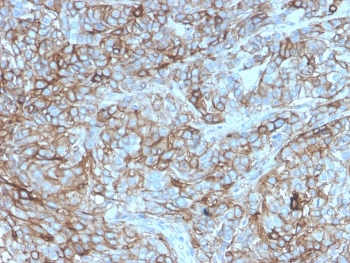 IHC staining of FFPE human breast carcinoma with recombinant mouse PD-L1 antibody (clone rPDL1/4772). HIER: boil tissue sections in pH 9 10mM Tris with 1mM EDTA for 20 min and allow to cool before testing.