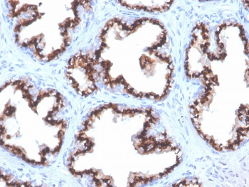 Prostein Antibody for IHC. Immunohistochemistry analysis of Prostein / SLC45A3 antibody staining in FFPE human prostate carcinoma using clone ZR9. Strong cytoplasmic and perinuclear staining is observed in tumor epithelial cells forming glandular structures, consistent with Golgi-associated localization of Prostein, while surrounding stromal components remain largely negative. The staining highlights prostate epithelial differentiation within malignant glands and preserves luminal cell architecture, supporting the role of SLC45A3 as a prostate lineage marker in carcinoma tissue. Heat-induced epitope retrieval was performed in pH 9 Tris-EDTA buffer for 20 minutes followed by cooling prior to antibody incubation.