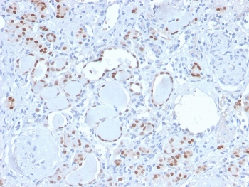PAX8 Antibody / Renal Epithelial Lineage Marker Antibody immunohistochemistry in human kidney tissue showing nuclear HRP-DAB brown staining in renal tubular epithelial cells. Paired box protein Pax-8 (PAX8) expression is localized to nuclei lining nephron tubules, with clear staining of epithelial cells forming tubular structures and minimal signal in surrounding stromal or interstitial compartments. The staining pattern highlights renal epithelial lineage specificity, with strong nuclear positivity in tubular epithelium and absence of staining in non-epithelial cells. This distribution supports the use of PAX8 as a renal lineage marker in tissue-based analysis. HIER: boil tissue sections in pH 9 10mM Tris with 1mM EDTA for 20 min and allow to cool before testing.