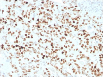 p21 / p21WAF1 Antibody Human Colon Carcinoma Tissue IHC. Immunohistochemistry staining of FFPE human colon carcinoma with recombinant p21 antibody (clone CIP1/4377R). HIER: boil tissue sections in pH 9 10mM Tris with 1mM EDTA for 20 min and allow to cool before testing.