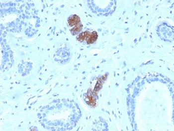 Mammaglobin Antibody - HuProt Validated immunohistochemistry of human breast carcinoma. FFPE human breast carcinoma tissue was stained with Mammaglobin Antibody - HuProt Validated (clone MGB/4056). HRP-DAB brown chromogenic signal highlights cytoplasmic staining in clusters of tumor epithelial cells within glandular structures, consistent with expression of Mammaglobin A / SCGB2A2 in breast carcinoma cells, while surrounding stromal cells show little to no staining. Heat-induced epitope retrieval was performed by boiling tissue sections in pH 9 10mM Tris with 1mM EDTA for 20 minutes followed by cooling prior to staining.