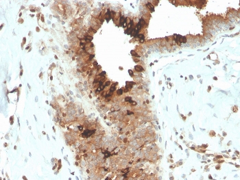 Mammaglobin Antibody - Microarray Specificity Validation (clone MGB/4057R) immunohistochemistry of human breast carcinoma. FFPE human breast carcinoma tissue was stained with Mammaglobin Antibody - Microarray Specificity Validation (clone MGB/4057R). HRP-DAB brown chromogenic signal highlights cytoplasmic staining in tumor epithelial cells lining glandular structures, consistent with expression of Mammaglobin A / SCGB2A2 in breast carcinoma cells, while surrounding stromal cells show little to no staining. Heat-induced epitope retrieval was performed by boiling tissue sections in pH 9 10mM Tris with 1mM EDTA for 20 minutes followed by cooling prior to staining.