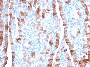 IHC staining of FFPE human thyroid carcinoma with TPO antibody. HIER: boil tissue sections in pH 9 10mM Tris with 1mM EDTA for 20 min and allow to cool before testing.