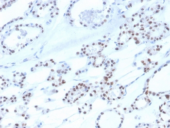PAX8 Antibody / Differential Diagnosis Panel Marker Antibody immunohistochemistry in human thyroid tissue showing strong nuclear HRP-DAB brown staining in follicular epithelial cells. Paired box protein Pax-8 (PAX8) expression is localized to nuclei lining thyroid follicles, with clear staining of epithelial cells surrounding colloid-filled lumina and minimal signal in stromal components. The distinct nuclear staining pattern supports its role within differential diagnosis panels, where PAX8 positivity can be interpreted alongside other lineage markers to distinguish thyroid-derived tumors from morphologically similar malignancies. Negative cells retain hematoxylin-only nuclear staining, providing clear contrast for panel-based interpretation. HIER: boil tissue sections in pH 9 10mM Tris with 1mM EDTA for 20 min and allow to cool before testing.