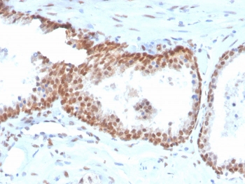 p40 Antibody Biotin Conjugate. Immunohistochemistry analysis of Tumor protein p40 (deltaNp63) in FFPE human prostate tissue using a p40 Antibody Biotin Conjugate (clone TP40/3980R) demonstrates strong HRP-DAB brown nuclear staining in basal epithelial cells outlining glandular structures, with luminal epithelial cells remaining negative. The nuclear staining is intense and well-defined, forming a continuous basal cell layer pattern that clearly delineates gland architecture. The enhanced signal intensity is consistent with the high affinity of the recombinant rabbit monoclonal format combined with biotin-streptavidin amplification, resulting in robust nuclear detection with minimal background. Surrounding stromal cells remain largely unstained, providing clear contrast and supporting accurate interpretation of deltaNp63-positive basal cell populations. Heat-induced epitope retrieval was performed by boiling tissue sections in pH 9 10mM Tris with 1mM EDTA for 20 minutes followed by cooling prior to antibody incubation.