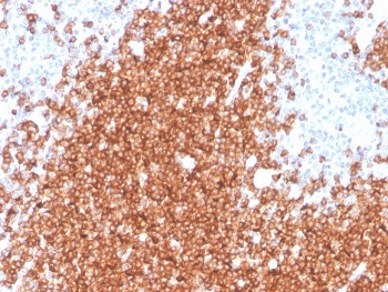 CD22 Antibody Spleen B-Cell Staining. Immunohistochemistry analysis of CD22/Siglec-2 expression in FFPE human spleen tissue using CD22 Antibody / B Cell Adhesion and Homing Marker Antibody clone rBLCAM/4108. Strong HRP-DAB brown membranous and cytoplasmic staining is concentrated within white pulp lymphoid follicles, highlighting dense B lymphocyte populations involved in cell-cell interactions and tissue localization, while surrounding red pulp regions and non-lymphoid cells show minimal staining. The distribution pattern aligns with CD22-mediated adhesion and homing functions that regulate B cell positioning within splenic microenvironments and supports use of this CD22 antibody for immunohistochemistry-based analysis of lymphoid architecture. Heat-induced epitope retrieval was performed in pH 9 Tris-EDTA buffer for 20 minutes followed by cooling prior to antibody incubation.